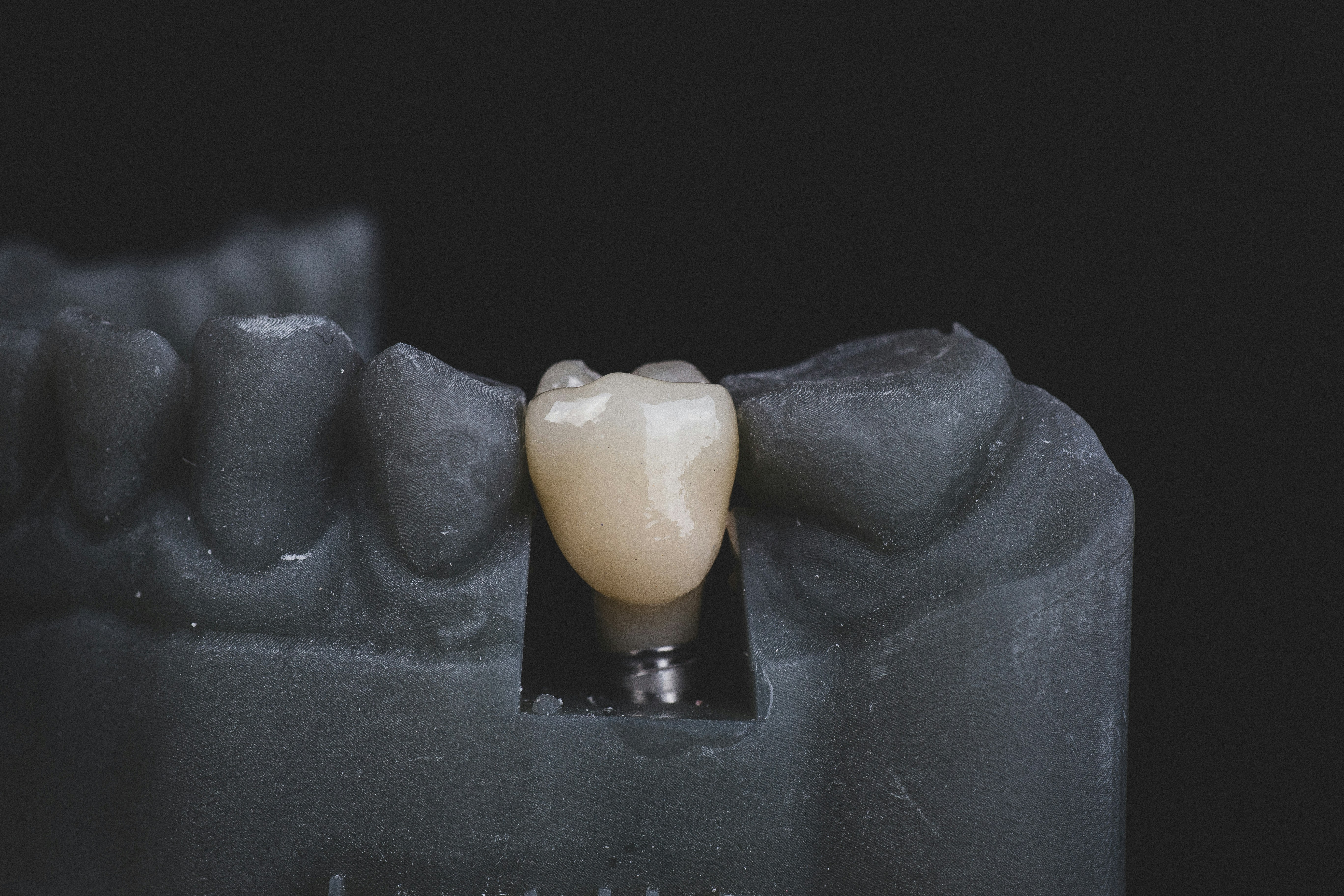 Implantes dentales: lo que debes saber antes de decidir